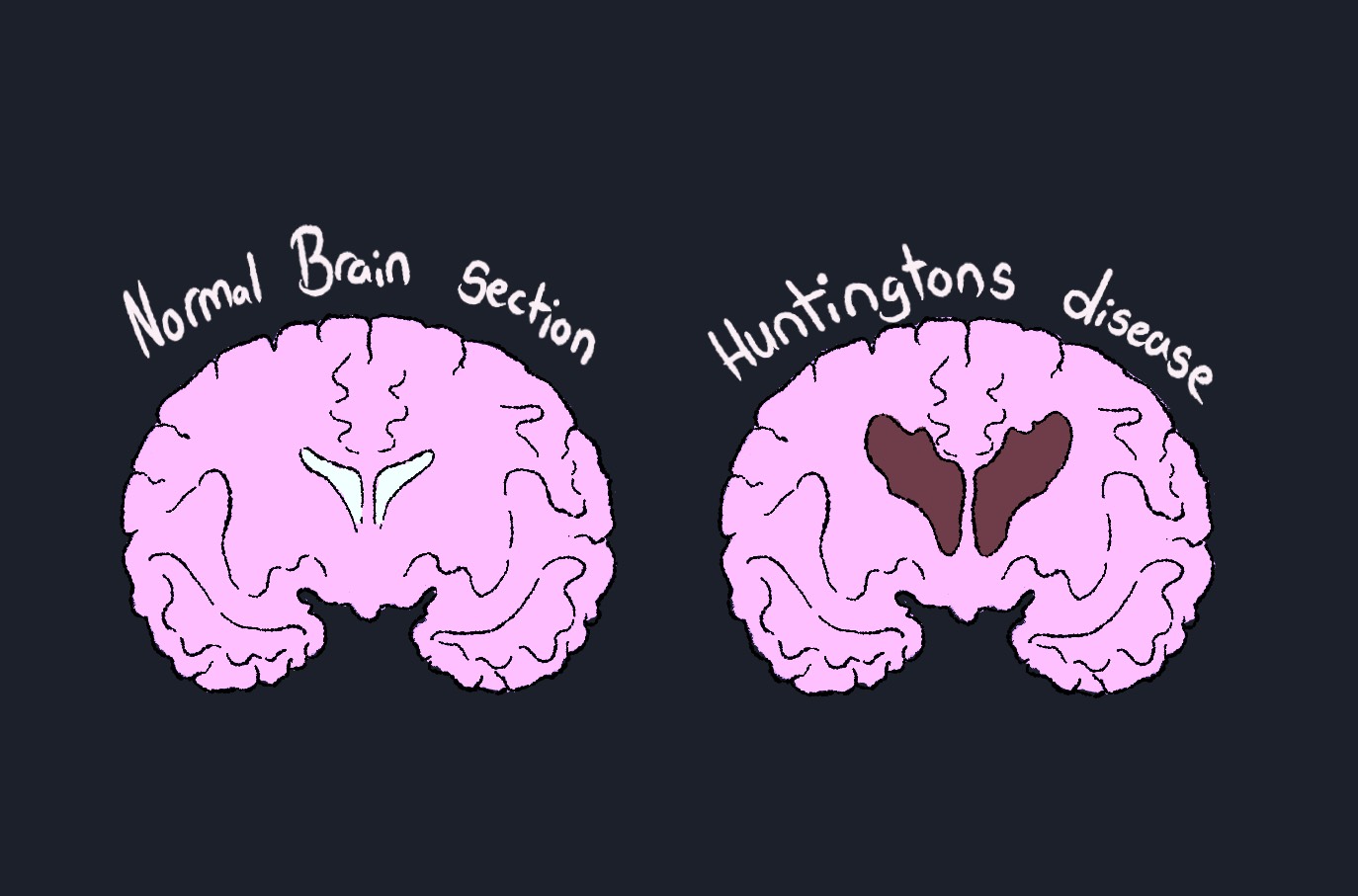 An Unwanted Inheritance, Finally Refused: Huntington’s Disease First Effective Treatment